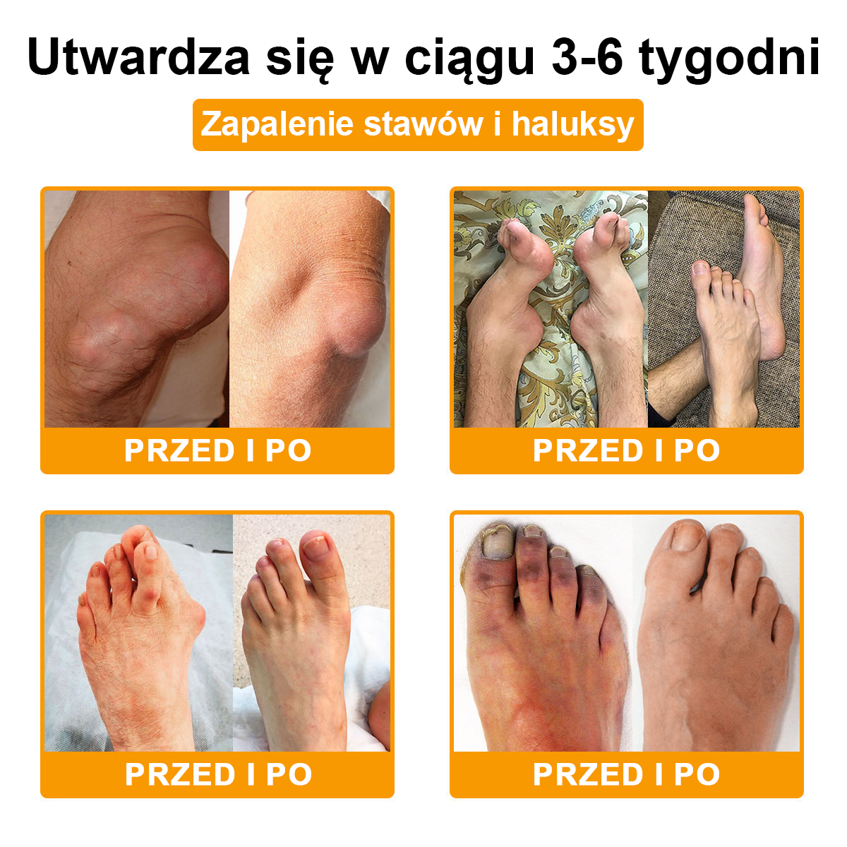 🦴TLOPA® Toksyna botulinowa i jad pszczeli Krem przeciwbólowy do gojenia kości🔥🔥🔥🔥🔥🔥